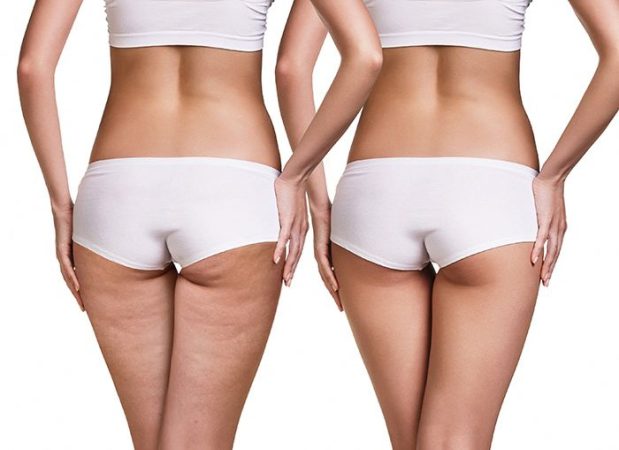 Cellulite-Treatment-that-has-Proven-Visible-Results-in-Adult-Women-Brookline-MA.jpg